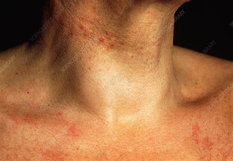 Swollen Neck Of Man With Benign Thyroid Cyst Stock Image M1300401