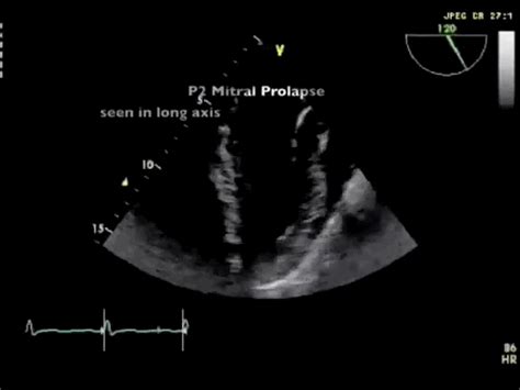 Mitral Valve Prolapse Long Axis Myheart
