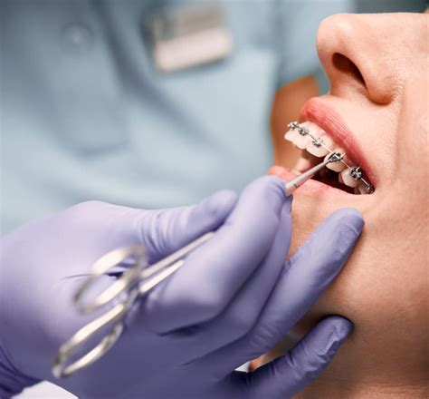 Choosing The Right Orthodontic Treatment Dr Vivek Cheba Calgary