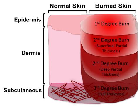 Classifications Of Burns