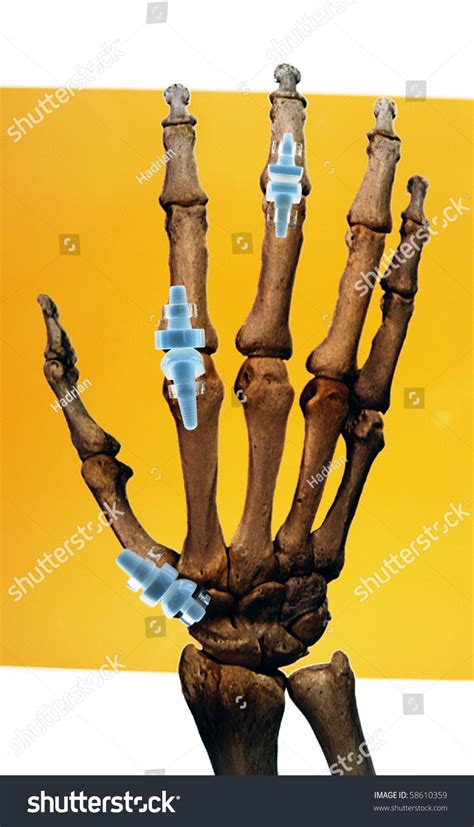 Artificial Implants In Human Hand Finger Joint Replacement Surgery