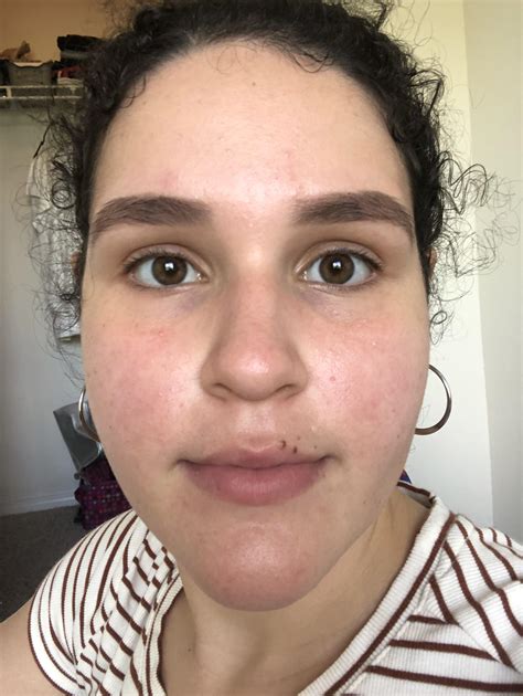 What Can I Do About The Redness On My Face Rskincareaddiction