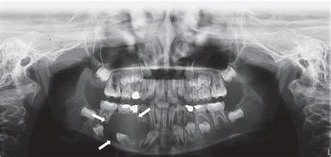 Figure 1 From Jaw Lesions Associated With Impacted Tooth A