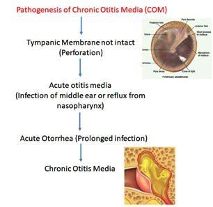 Otitis Media Pathophysiology Hot Sex Picture