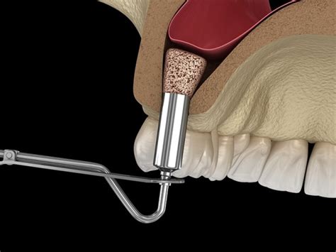Bone Grafting And Sinus Lifts In Aberdeen Kuhn Dental Associates