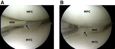 All Inside Arthroscopic Meniscal Repair Technique Using A Midbody Accessory Portal Arthroscopy