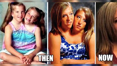 what conjoined twins abby and brittany hensel look like now