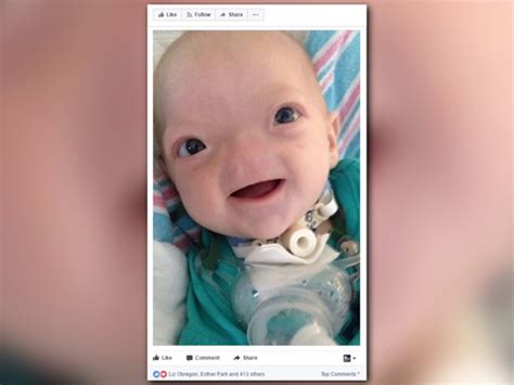 Eli Thompson Miracle Baby Born Without Nose Dies At 2 Years Old
