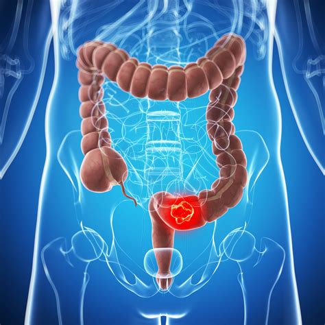 colorectal cancer types