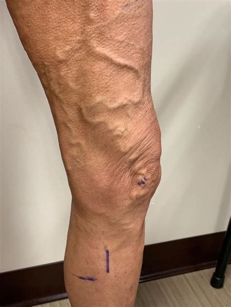 Varicose Veins No Surgery Laser Treatment The Vein And Laser Centre