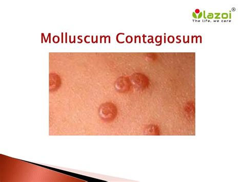 Ppt Molluscum Contagiosum Symptoms Causes Diagnosis Treatment And