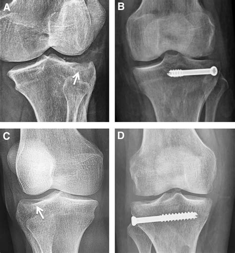 Preoperative And Postoperative Radiographs Of 2 Cases Of Schatzker Type