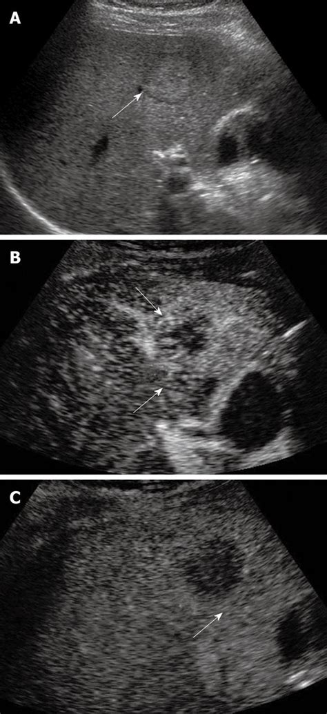 Liver Nodule Ultrasound