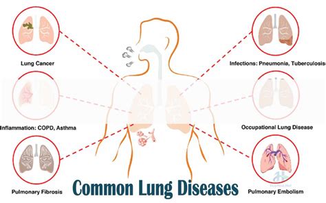 15 Common Dangerous Lung Diseases