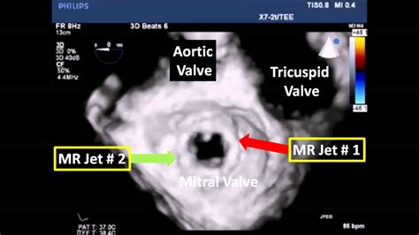 Bioprosthetic Mitral Valve With Large Paravalvular Leaks Youtube