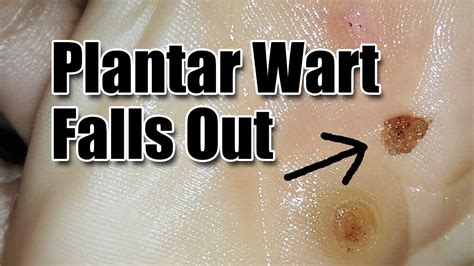 Stages Of Plantar Wart Removal What Are The Different Stages Of Wart