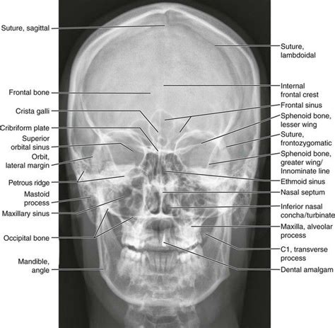 Skull Caldwell Radiology Student Medical Radiography