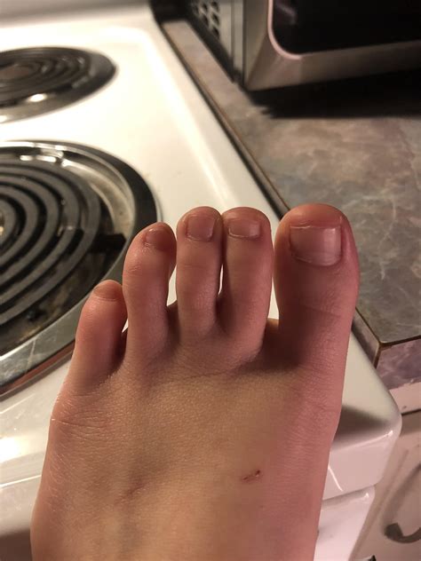 What Is Wrong With My Fourth Toe Why Is It Bent Like This My Mom