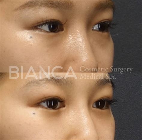 Eye Fat Removal Surgery Lower Blepharoplasty For Eyes Rejuvenation Trambellir