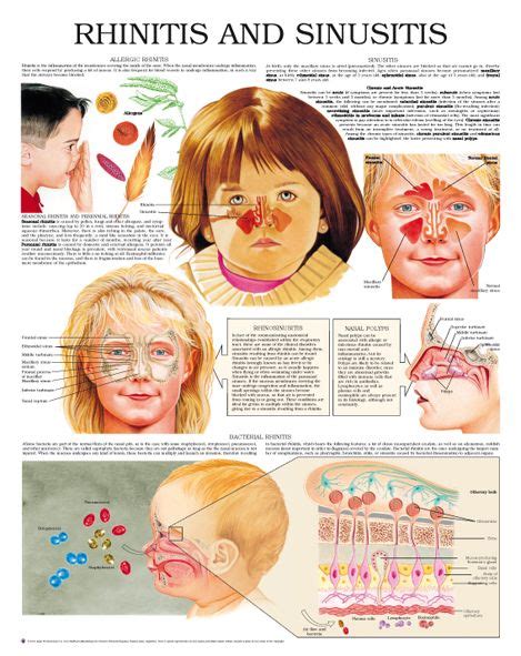 Rhinitis And Sinusitis Sinusitis Medical Knowledge Medical Studies