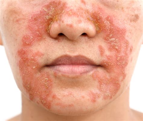 Dermatite Seborroica Cos Quali Sono I Sintomi E Come Si Cura Ohga