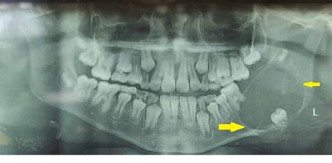 Ameloblastoma X Ray