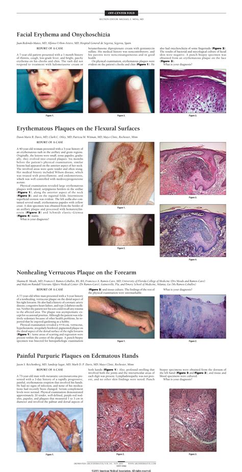 Erythematous Plaques On The Flexural Surfaces—diagnosis Dermatology