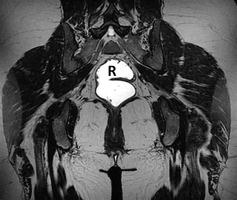 Translabial Us And Dynamic Mr Imaging Of The Pelvic Floor Normal Anatomy And Dysfunction