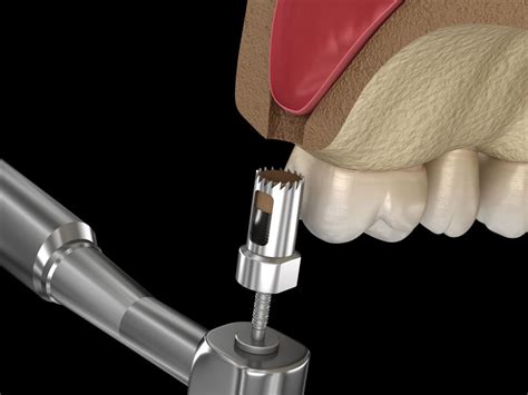Bone Grafts Kikuchi Oral Surgery And Dental Implant Center