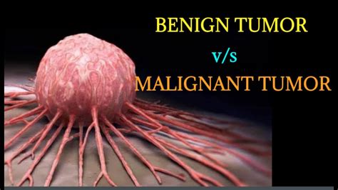 differences between benign and malignant tumor youtub
