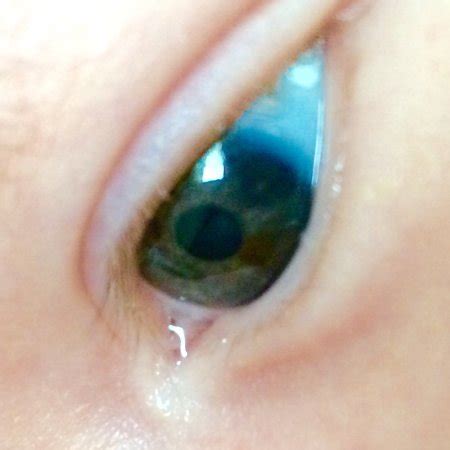 Eye redness is most often due to swollen or dilated blood vessels. Dark red/brown spot on my baby's eye iris - Page 1 ...