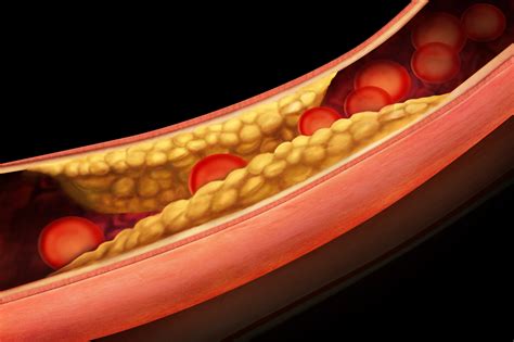 What Is Atherosclerosis