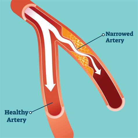 Peripheral Artery And Vascular Disease Manhattan Cardiovascular Associates