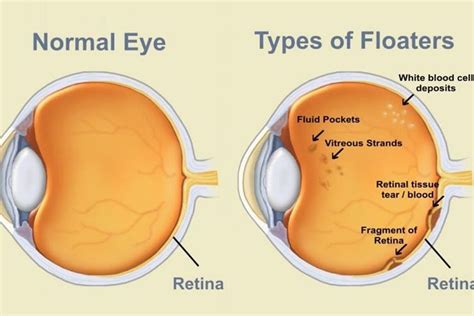 The Causes And Treatment Of Eye Floaters The Eye News