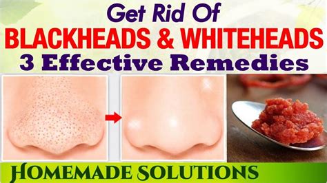 How To Remove Blackheads And Whiteheads In Just 1 Application Naturally