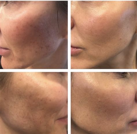 Laser Skin Resurfacing In Avon Radiant Divine Medical Spa