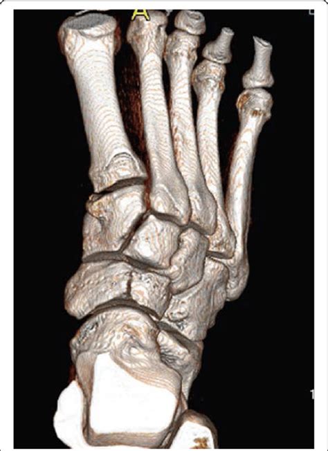 Three Dimensional Ct Scan Of The Right Foot Demonstrating Grade Iii