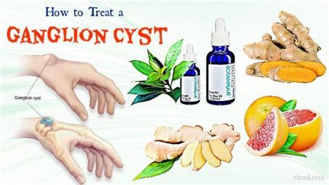 Ganglion cysts in toe can be particularly problematic for wearing shoes or sandals with a pointed tip. 21 Ways On How To Treat A Ganglion Cyst Naturally At Home