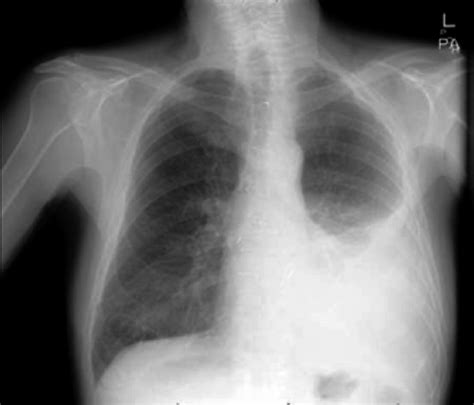 The pleura is a thin membrane that lines the inside of the chest wall and covers the lungs. Chest X-ray of a left-sided pleural effusion | Download ...