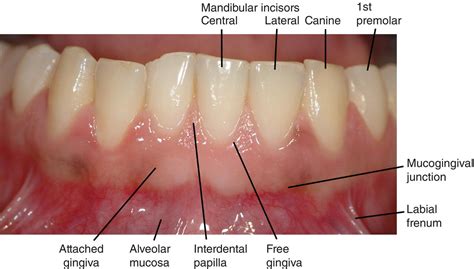 Gum Recession On One Tooth Rdentistry