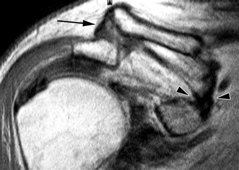 Mr Imaging Appearances Of Acromioclavicular Joint Dislocation