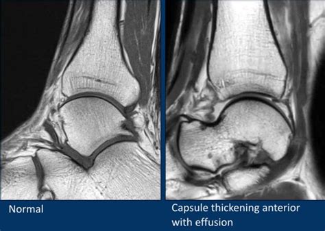 The Radiology Assistant Mri Examination Of The Ankle