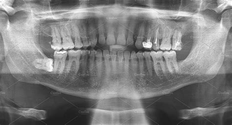 Dental Panoramic Radiograph High Quality Health Stock Photos