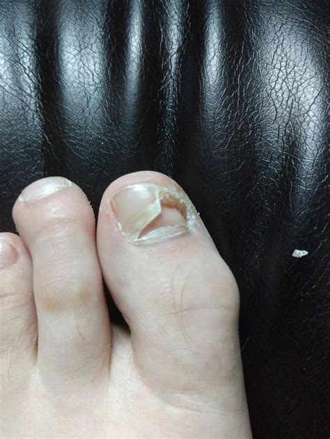 I Have A Toenail Growing Under My Toenail Toe Nails Human Feet