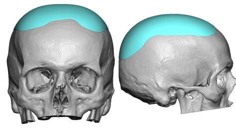 Plastic Surgery Case Study Custom Skull Implant For Increasing The