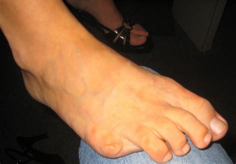 Causes Of A Lost Toe Almawi Limited The Holistic Clinic