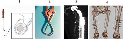 Cerclage Placement 1 Cable Passer Hook 2 Minimally Invasive