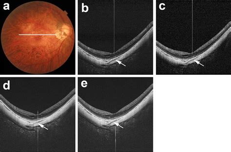 Real Scleral Vessels Without Artifactual Structures In Pd Oct Images