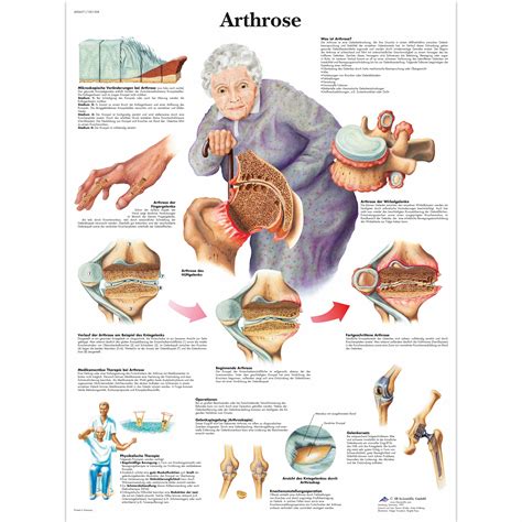 Arthrose 4006571 3b Scientific Vr0123uu Arthritis Patient Education Arthritis Models