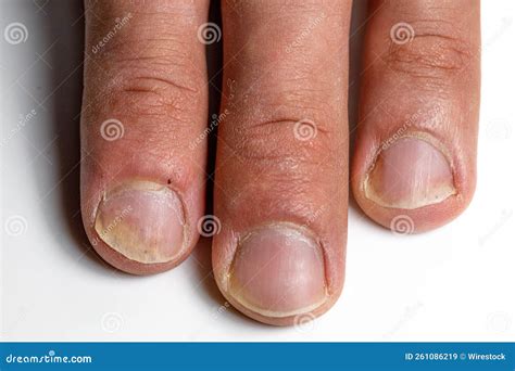 Closeup Of The Fingers Of A Patient With Psoriatic Onychodystrophy Or